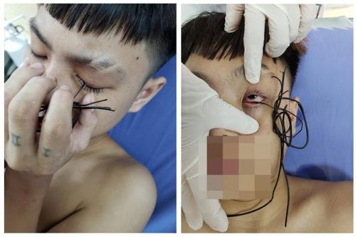 Lõi sợi dây điện đâm xuyên mi mắt chàng trai 16 tuổi