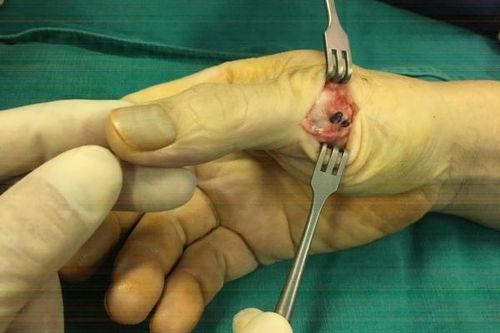 Kỹ thuật mới giúp chấn thương khớp bàn tay do chơi thể thao phục hồi nhanh