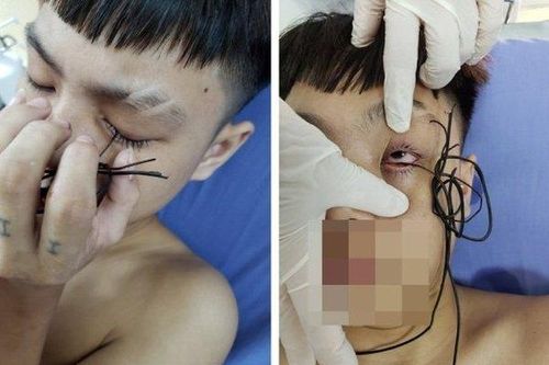 Ngã trong khi đùa nghịch, nam thanh niên 16 tuổi bị dây kim loại đâm thủng mi mắt