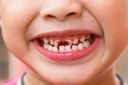 5 món ăn vặt hấp dẫn nhưng nằm trong danh sách 'đen', ảnh hưởng đến men răng của trẻ
