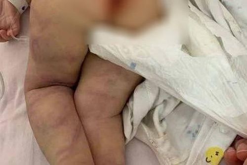 Mẹ đưa con 1 tuổi đến viện, bác sĩ phát hiện sự thật khủng khiếp sau những vết bầm tím