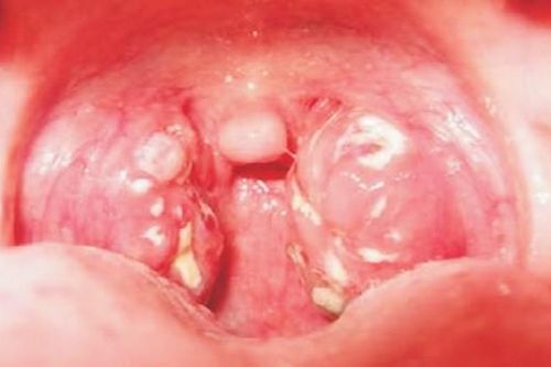 Ghi nhận 1 ca nhiễm bạch hầu tại Gia Lai