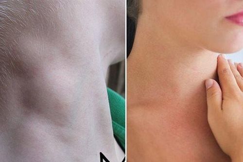Đừng dại mà bỏ qua những dấu hiệu ung thư hạch sớm này