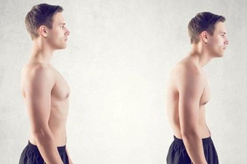 Gù lưng - căn bệnh kinh niên của dân văn phòng