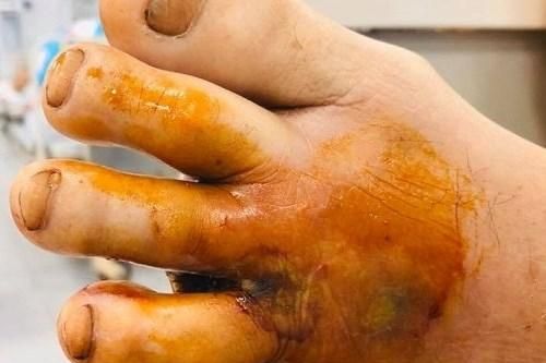 1 trường hợp mắc Whimore tại Hòa Bình
