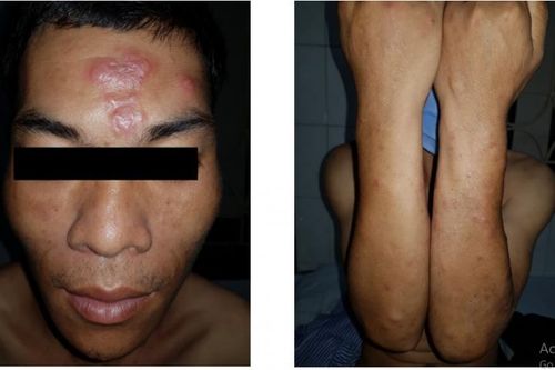 Ghi nhận ca bệnh phong cùi tại Lạng Sơn