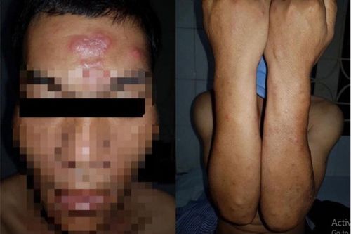 Phát hiện bệnh nhân 35 tuổi bị phong, căn bệnh này có dễ lây?