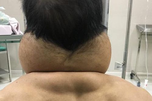Cơ thể biến dạng do nghiện rượu nhiều năm