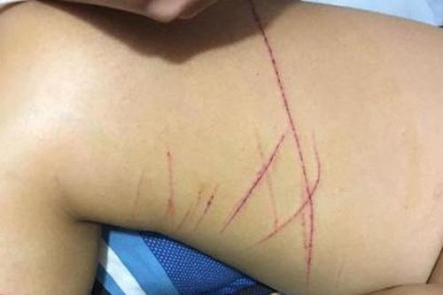 Điều tra vụ việc nữ sinh bị rạch đùi trên đường đi học về