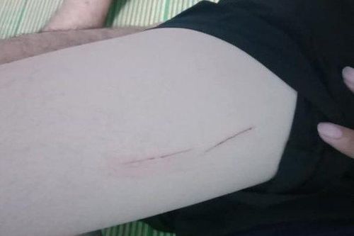 Nữ sinh TP.HCM bị kẻ lạ rạch đùi trên đường đi học về