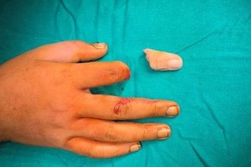 Kịp thời nối ngón tay đứt rời cho bé trai 11 tuổi