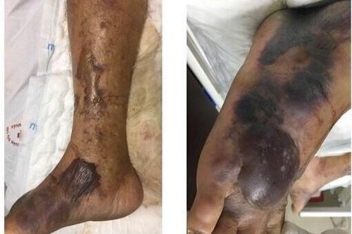 Chuyên gia y tế cảnh báo về ''vi khuẩn ăn thịt người'' đến từ biển