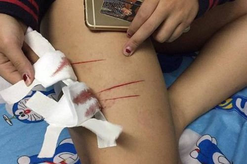 TP HCM: Điều tra vụ nữ sinh bị rạch đùi
