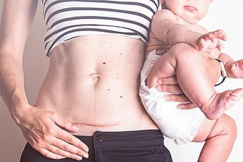 Những di chứng kéo dài sau sinh mổ