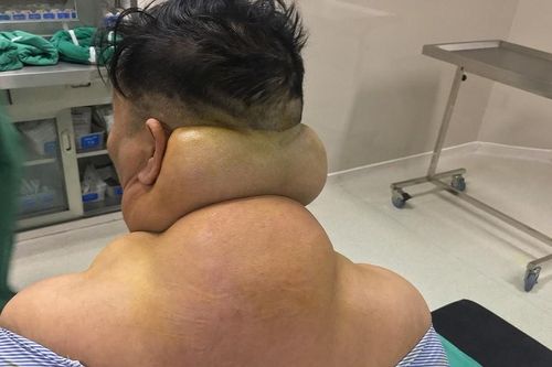 Sốc: Người đàn ông dị dạng, nổi u khổng lồ do rượu