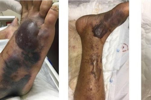 Những ai có thể nhiễm khuẩn 'ăn thịt người' và dễ mất mạng khi ăn hàu sống?