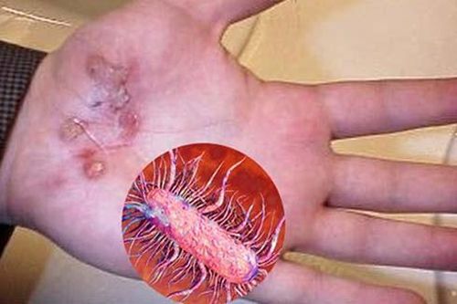 Cảnh giác loại vi khuẩn nguy hiểm này khi ăn hải sản có vỏ