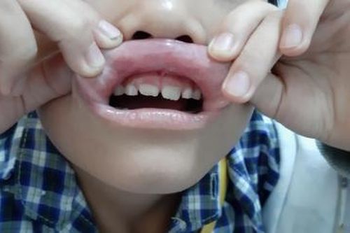 Điều trị thành công bệnh nhi bệnh Lichen