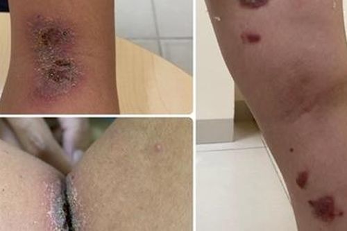 Nhiều người bị kiến ba khoang tấn công