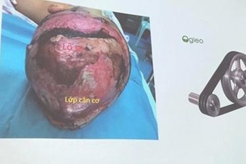 Tái tạo da đầu cho bé gái bị cuốn tóc vào máy xay nước đá