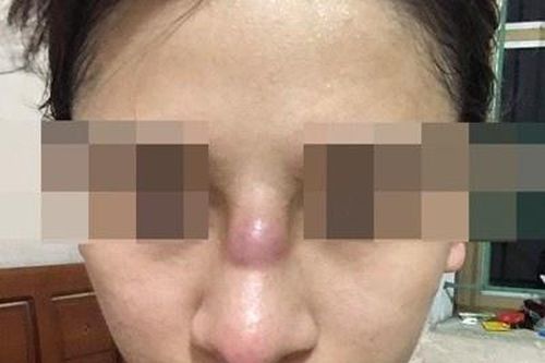 Cô gái 19 tuổi nhiễm trùng mũi sau khi làm đẹp ở spa