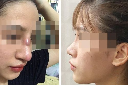 Nâng mũi thẩm mỹ tại spa, nữ sinh suýt thủng vách mũi