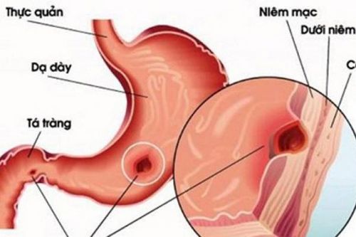 Có nên đổi thuốc băng se niêm mạc dạ dày