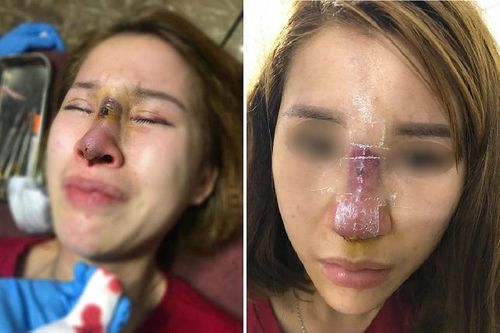 'Sốc toàn tập' trước biến chứng hậu phẫu thuật nâng mũi