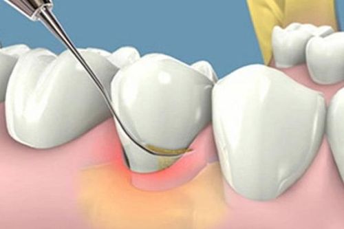 Hệ lụy của cao răng