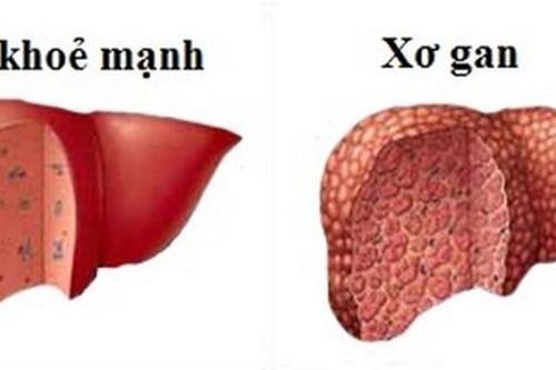 Không chủ quan với bệnh viêm gan siêu vi