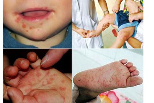 Gần 11.000 ca mắc tay chân miệng, Bộ Y tế khẩn cấp yêu cầu giảm tối đa số ca mắc và tử vong