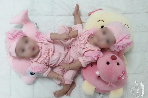 Ngày mai 15-7 sẽ phẫu thuật tách rời 2 bé gái dính liền vùng bụng