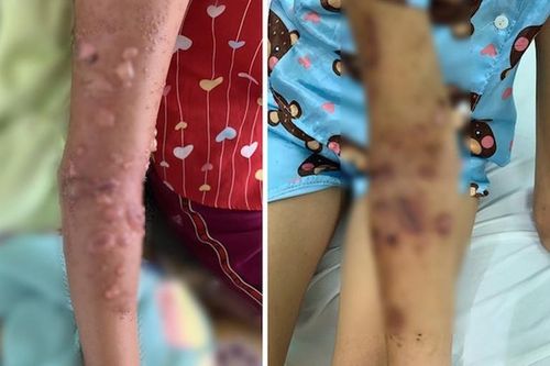 Bé gái bị bỏng nặng vì sứa 'cắn': Cách sơ cứu đúng cần biết