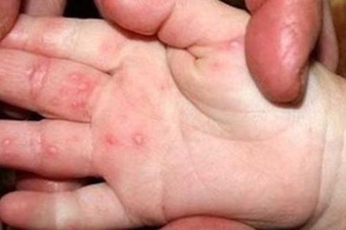 Gia tăng trẻ nhập viện do mắc tay chân miệng