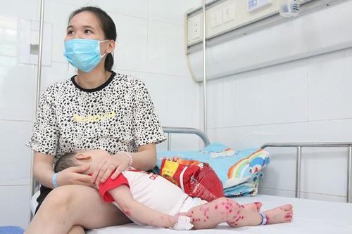 Tay chân miệng tăng gấp 6, có trẻ phải dùng tim phổi nhân tạo