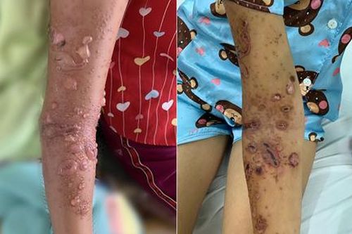 Bé gái phồng rộp cánh tay vì sứa biển