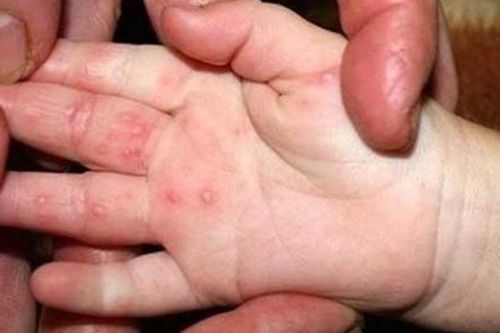 Bộ Y tế: Thực hiện ngay '3 sạch' để phòng chống bệnh tay chân miệng