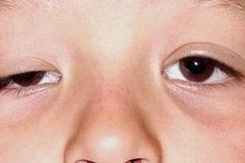 FDA phê chuẩn upneeq để điều trị sụp mí mắt ở người trưởng thành