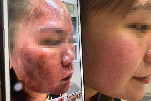 Bỏng da mặt vì tin vào mỹ phẩm lột da trôi nổi