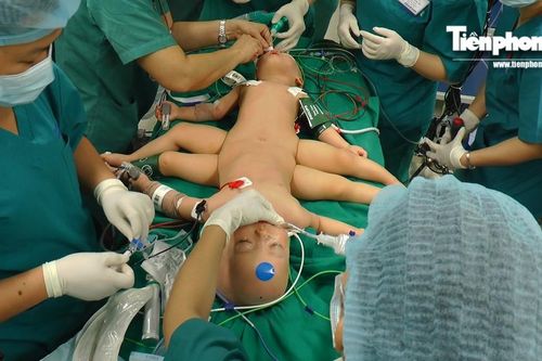 CLIP: Bên trong phòng mổ tách cặp song sinh dính nhau ở TPHCM