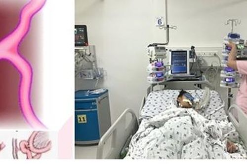 Cấp cứu bệnh nhi thoát vị nội hiếm gặp