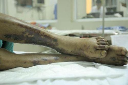 Người phụ nữ nhiễm liên cầu lợn không rõ nguồn lây