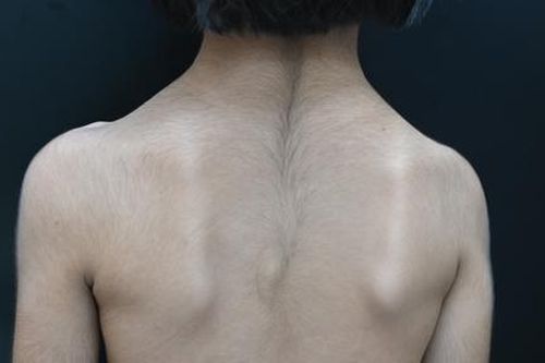 Bé gái 6 tuổi mắc bệnh kỳ lạ trên thế giới, lông mọc khắp người
