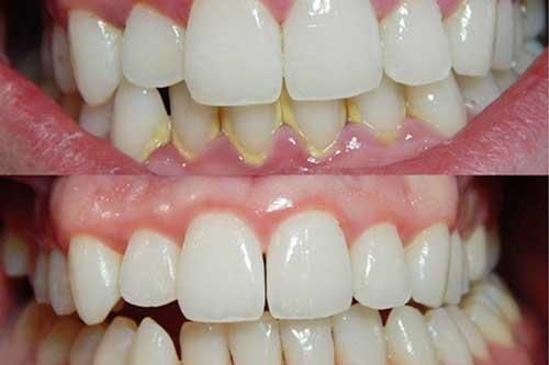 Làm điều này 3 phút buổi tối, cả đời chẳng phải đến nha sỹ lấy cao răng