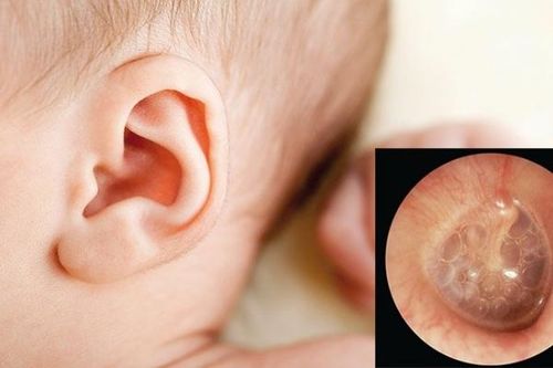 Viêm tai giữa cấp có nguy hiểm?