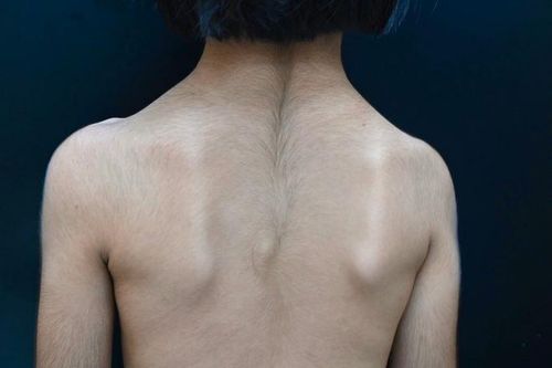 Căn bệnh lạ bé gái đầu tiên ở Việt Nam mắc phải nguy hiểm thế nào?