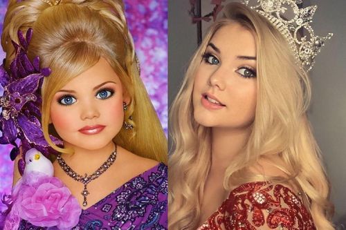 Tuổi thơ 'chín ép', phải tiêm botox mặt từ 4 tuổi của hoa hậu nhí