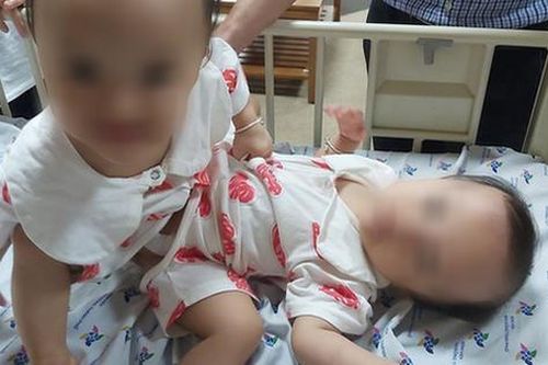 Điều ít biết về hiện tượng dị tật song sinh dính liền như cặp Song Nhi