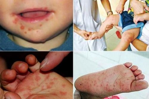 Hạn chế tử vong do bệnh tay chân miệng