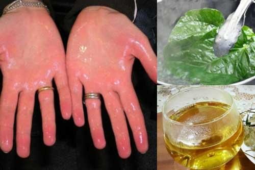 Làm theo cách này bất kể mồ hôi tay chân lâu năm đến đâu cũng khỏi